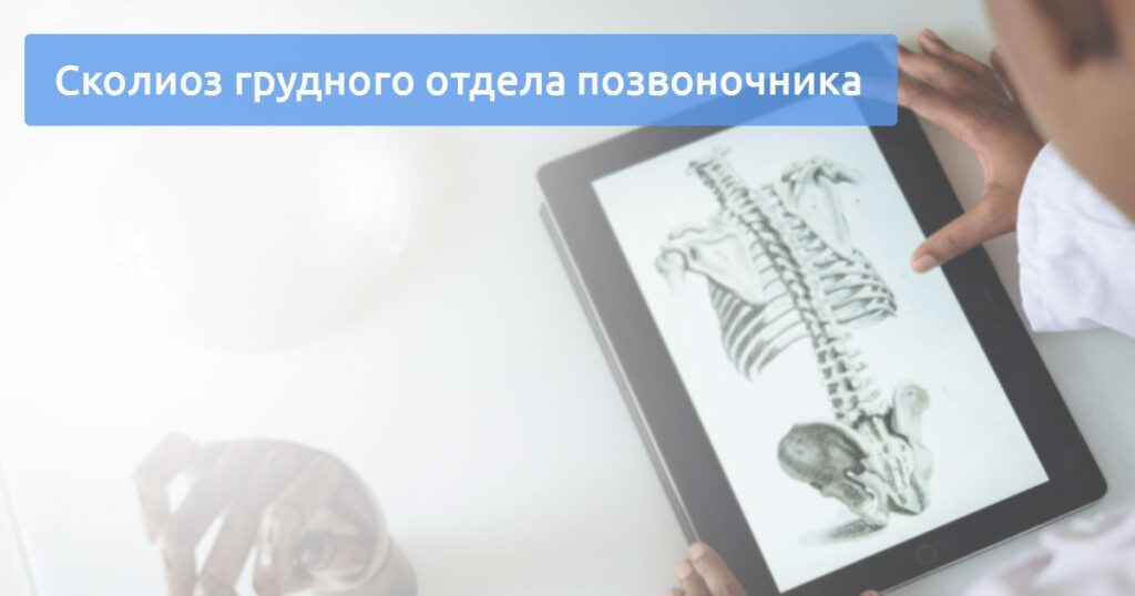 Сколиоз грудного отдела позвоночника