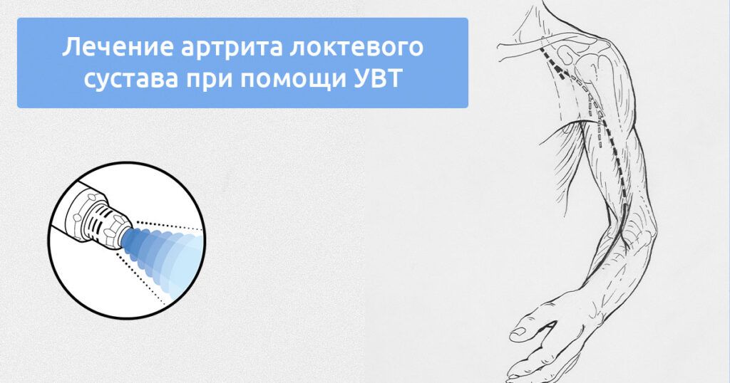 Артрит локтевого сустава: почему УВТ эффективна против боли и скованности
