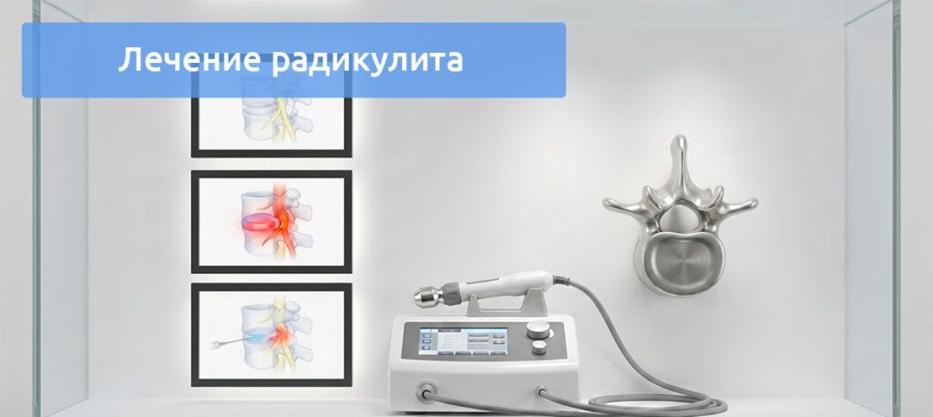 Лечение радикулита: современные методы и подходы