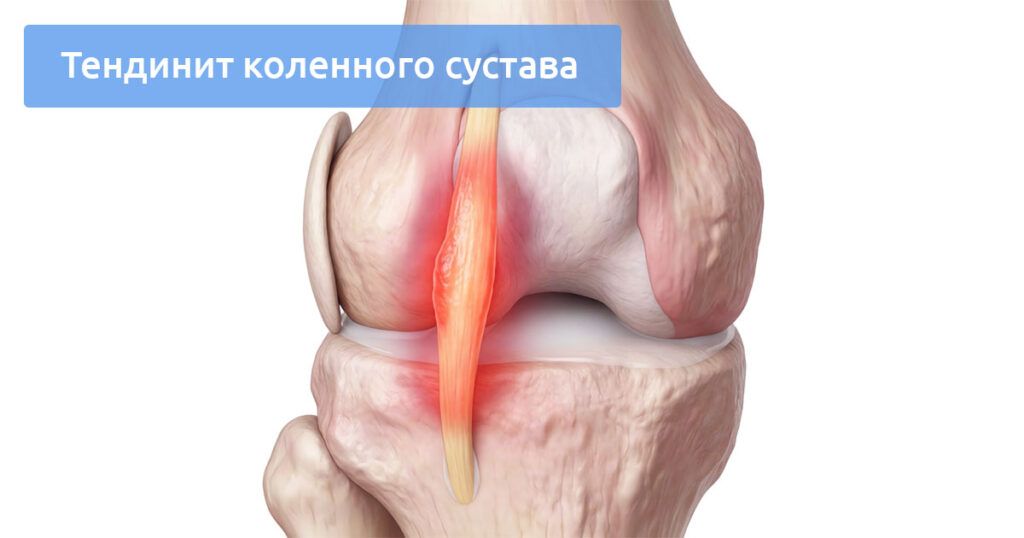 Тендинит коленного сустава: диагностика, симптомы и лечение